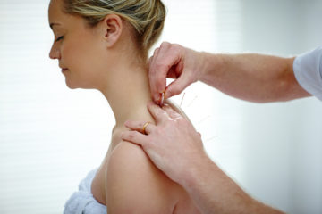 How dry needling can benefit you